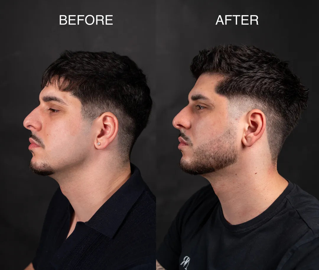 Beard Roller